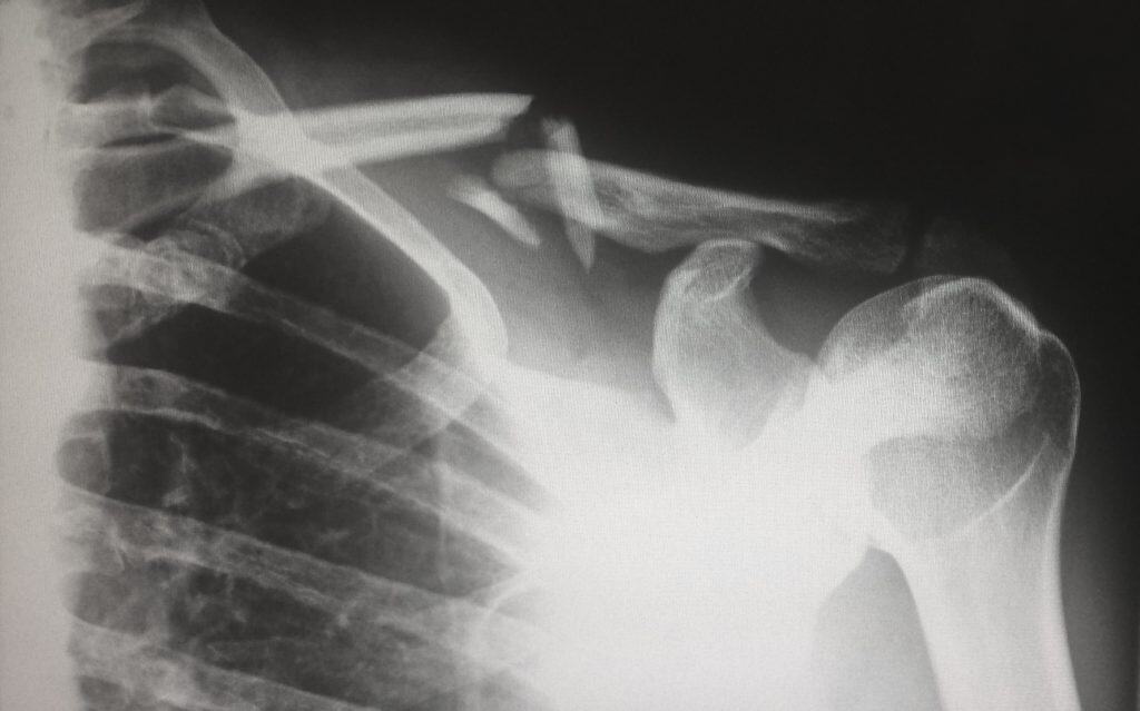 X-Ray - Photograph 51 Analysis